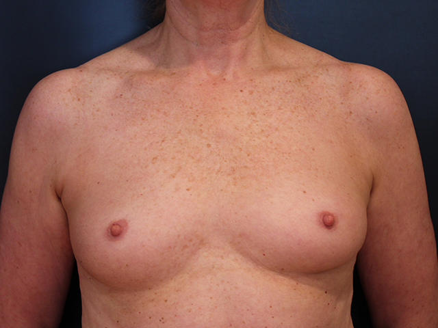 breast augmentation patient