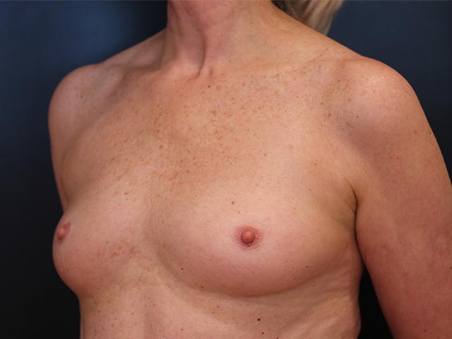 breast augmentation patient