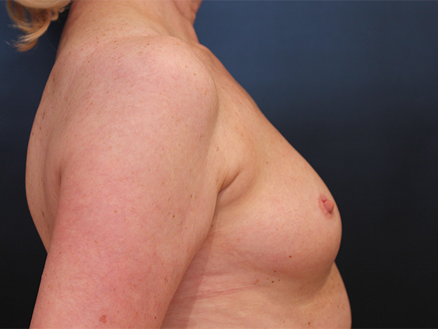breast augmentation patient