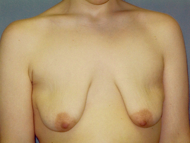 breast lift patient