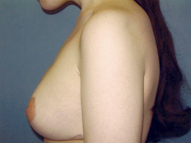 breast lift patient