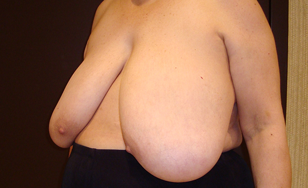breast reduction patient