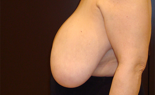 breast reduction patient