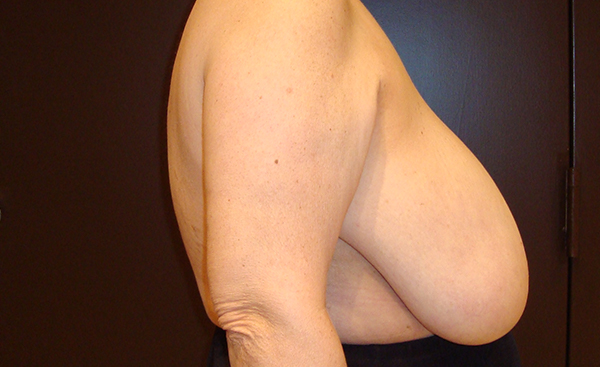 breast reduction patient