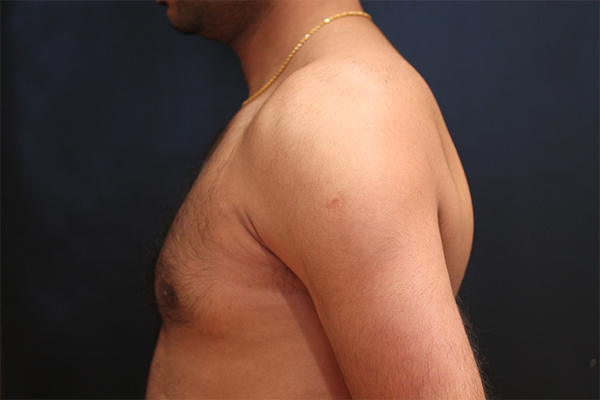 male breast reduction patient