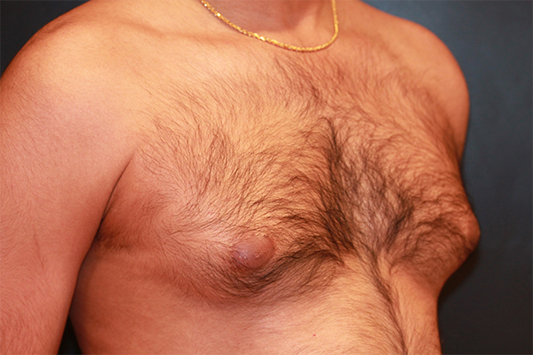 male breast reduction patient
