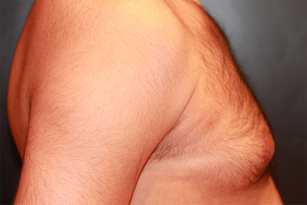 male breast reduction patient