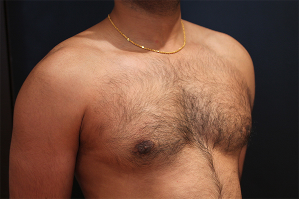 male breast reduction patient