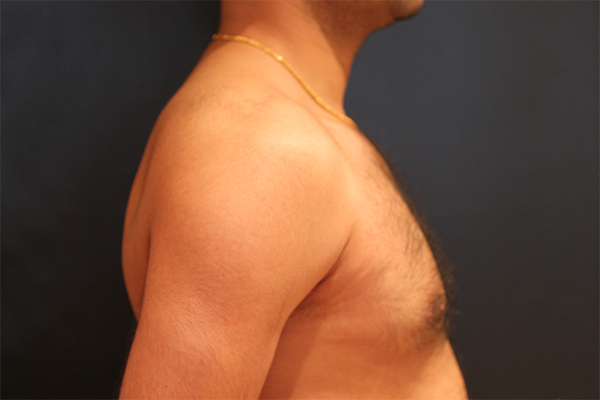 male breast reduction patient