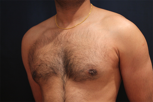 male breast reduction patient