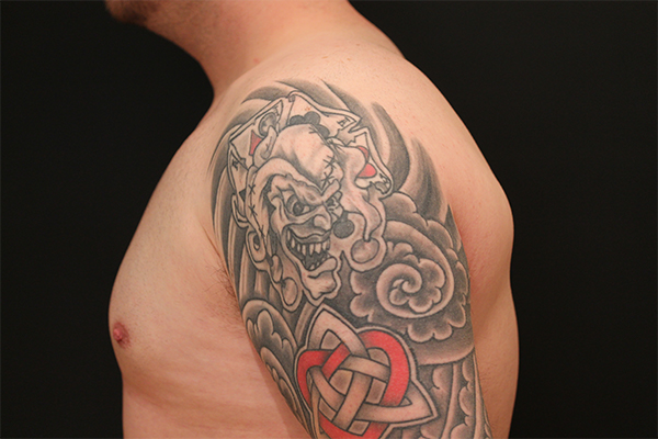 male breast reduction patient