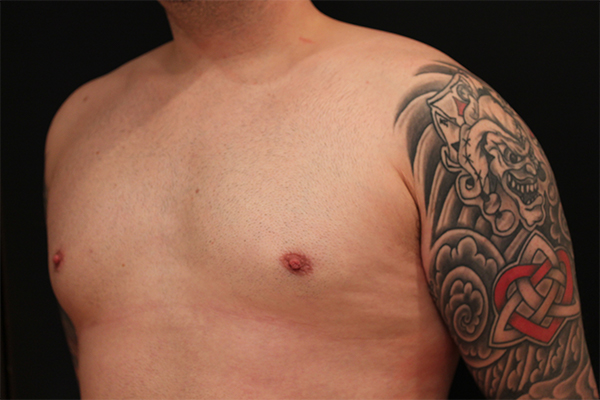 male breast reduction patient