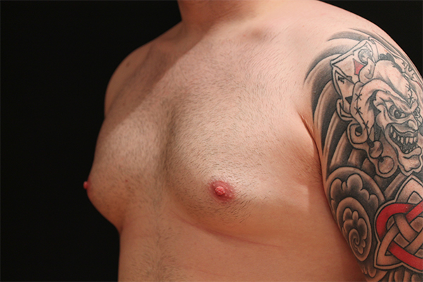male breast reduction patient