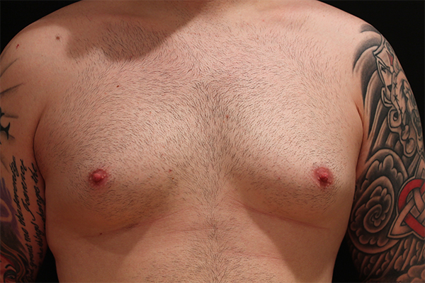 male breast reduction patient