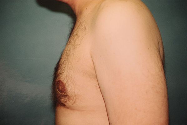 male breast reduction patient