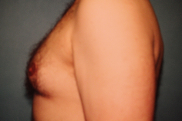 male breast reduction patient