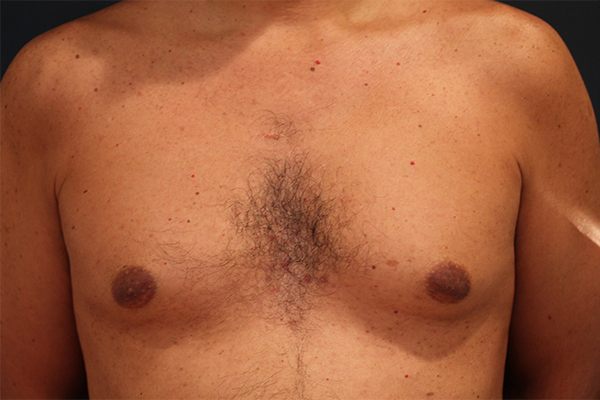 male breast reduction patient