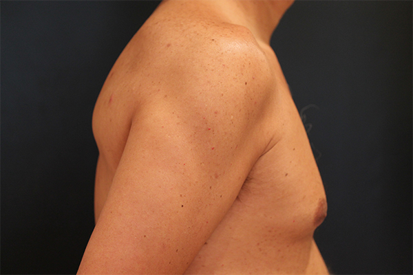male breast reduction patient