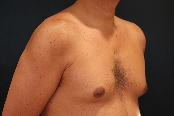 male breast reduction patient