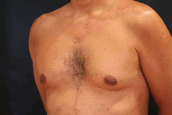 male breast reduction patient
