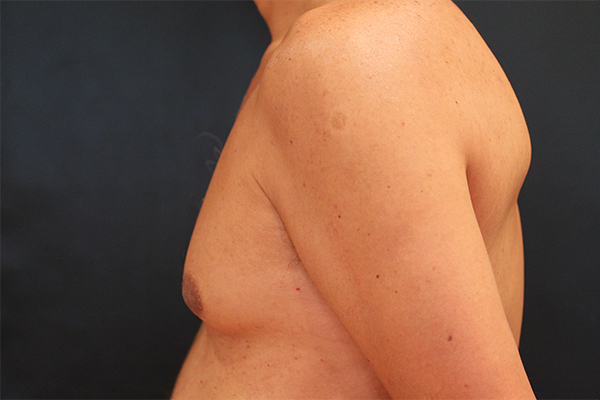 male breast reduction patient