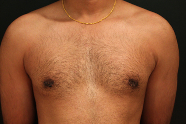 male breast reduction patient