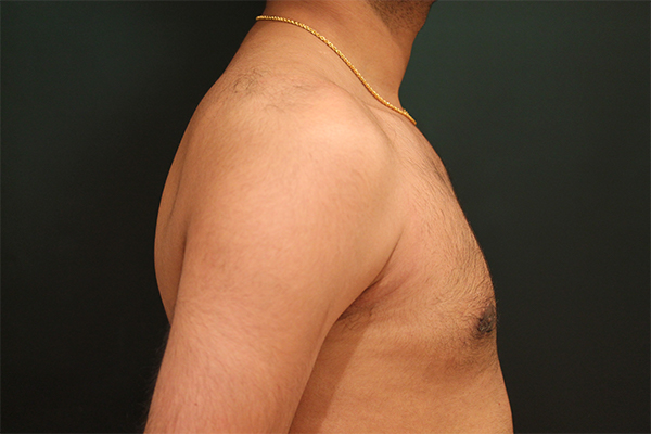 male breast reduction patient