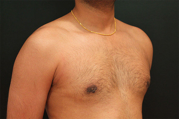 male breast reduction patient