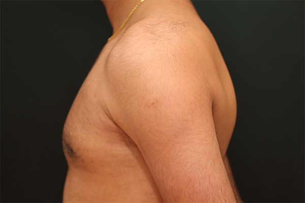 male breast reduction patient