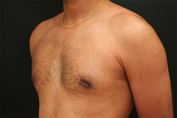 male breast reduction patient