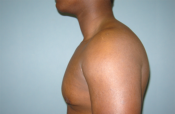 male breast reduction patient