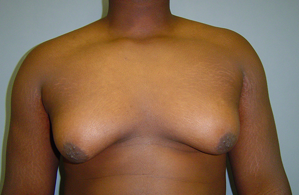 male breast reduction patient
