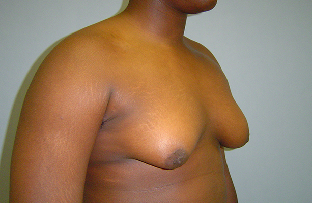 male breast reduction patient