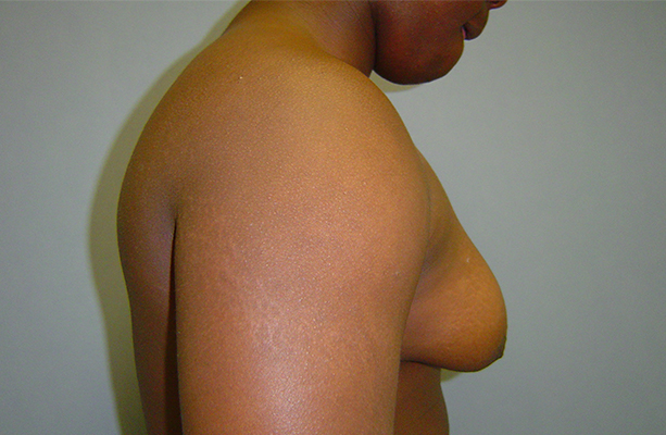 male breast reduction patient