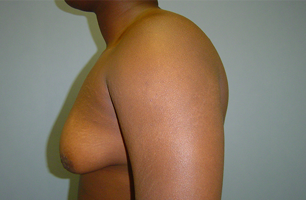 male breast reduction patient