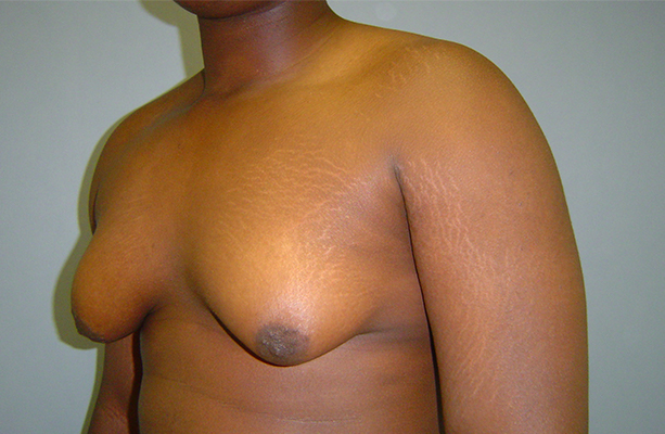male breast reduction patient