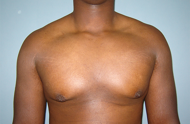 male breast reduction patient