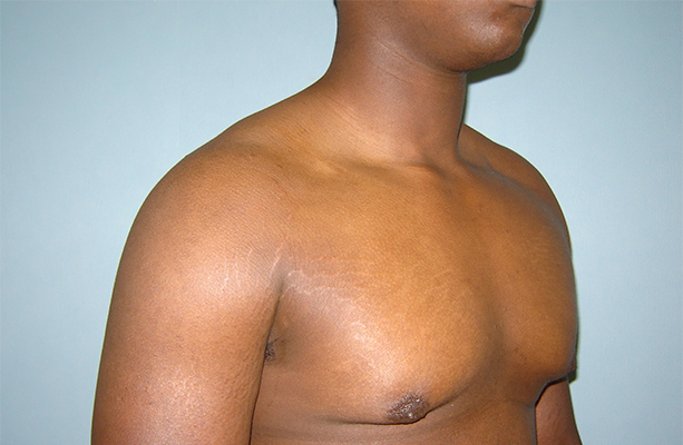 male breast reduction patient