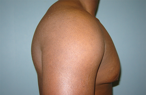 male breast reduction patient