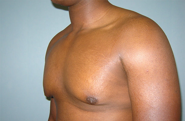 male breast reduction patient