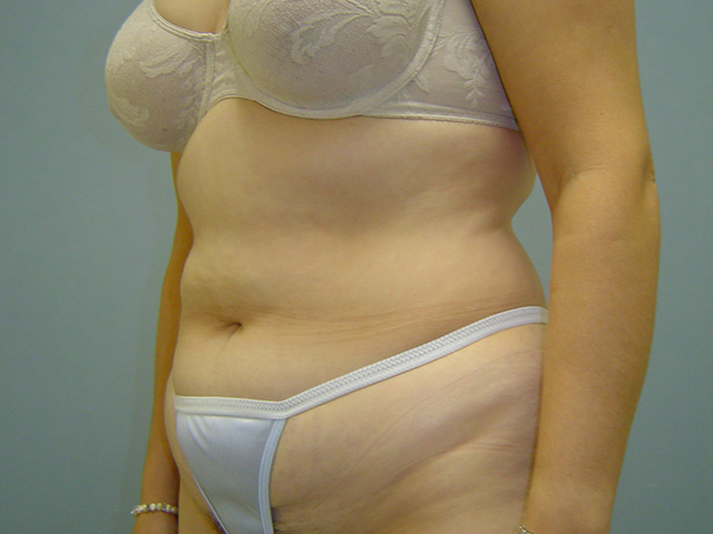 tummy tuck patient