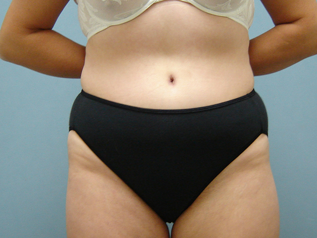 tummy tuck patient
