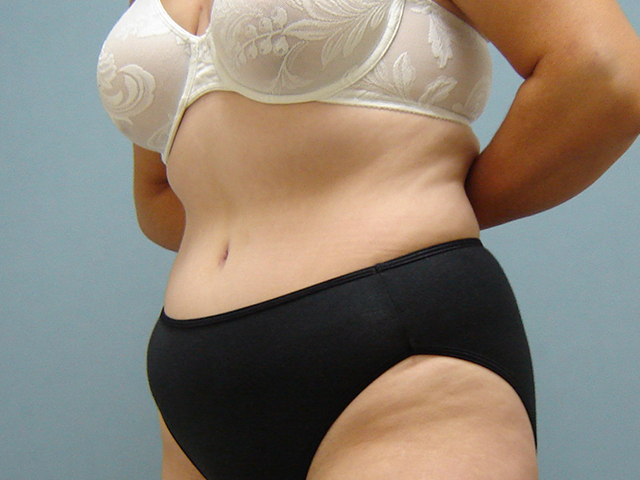 tummy tuck patient