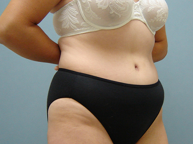 tummy tuck patient
