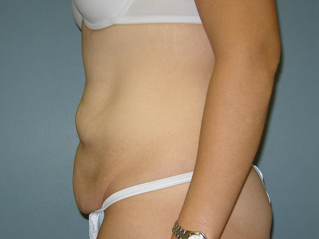 tummy tuck patient