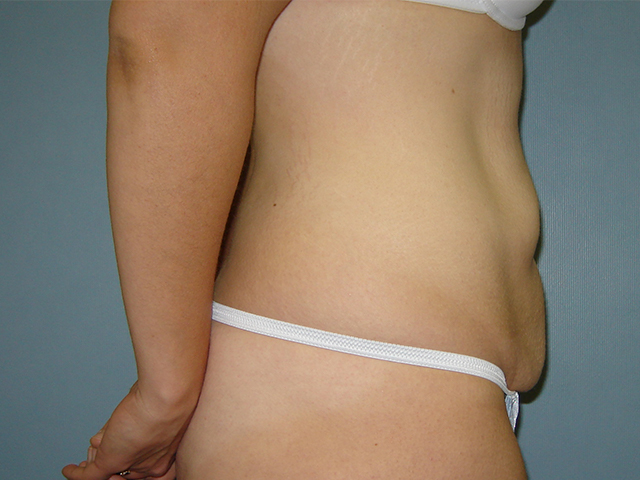 tummy tuck patient