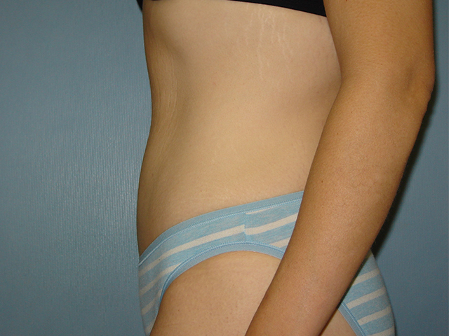tummy tuck patient