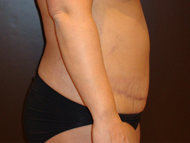 tummy tuck patient