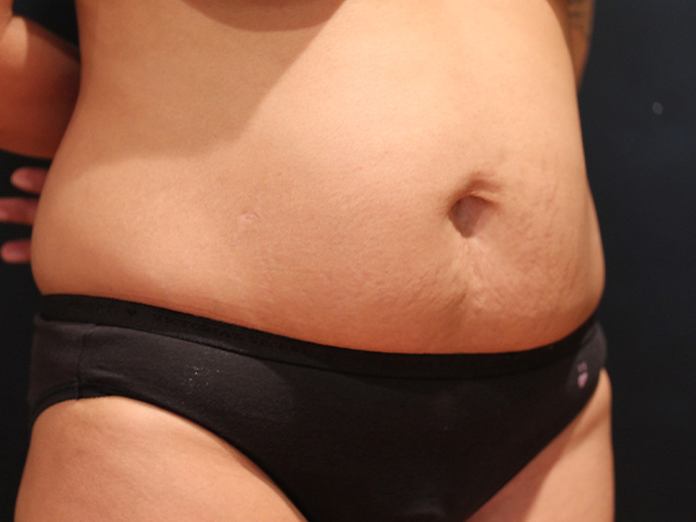 tummy tuck patient