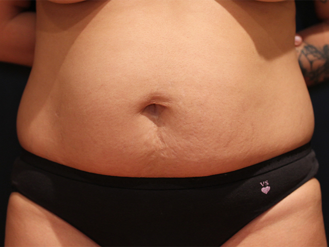 tummy tuck patient
